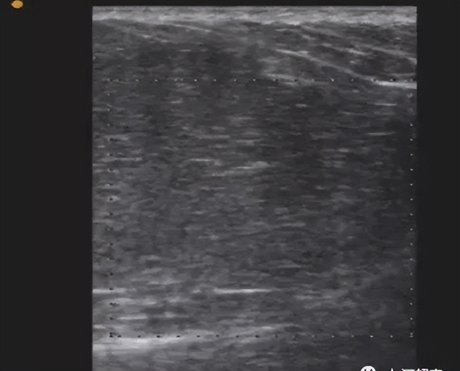 腋窝包块超声鉴别诊断,腋窝淋巴结检查法