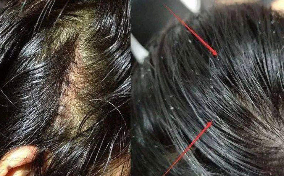 植物染发馆：你的头发容易油，可能是螨虫在作祟