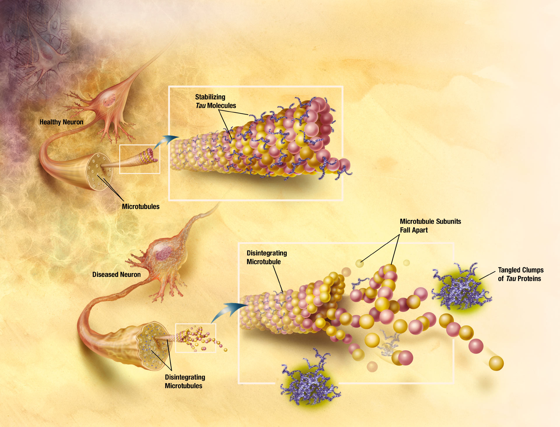 睡少了会加速衰老,睡少了脑子会变笨吗