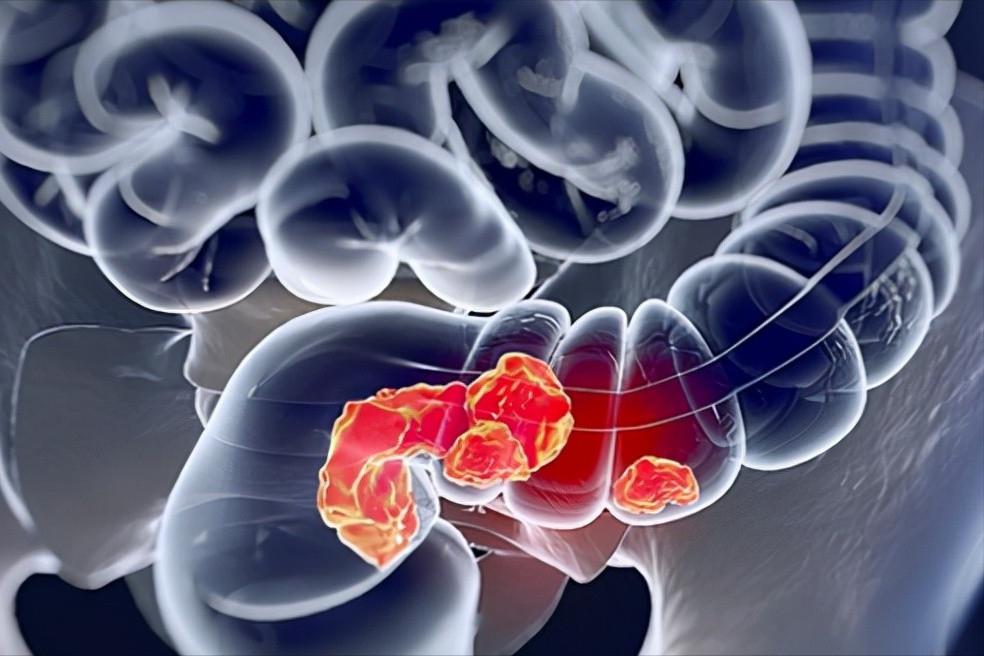 四物消风饮治疗慢性荨麻疹,四物消风饮治疗荨麻疹