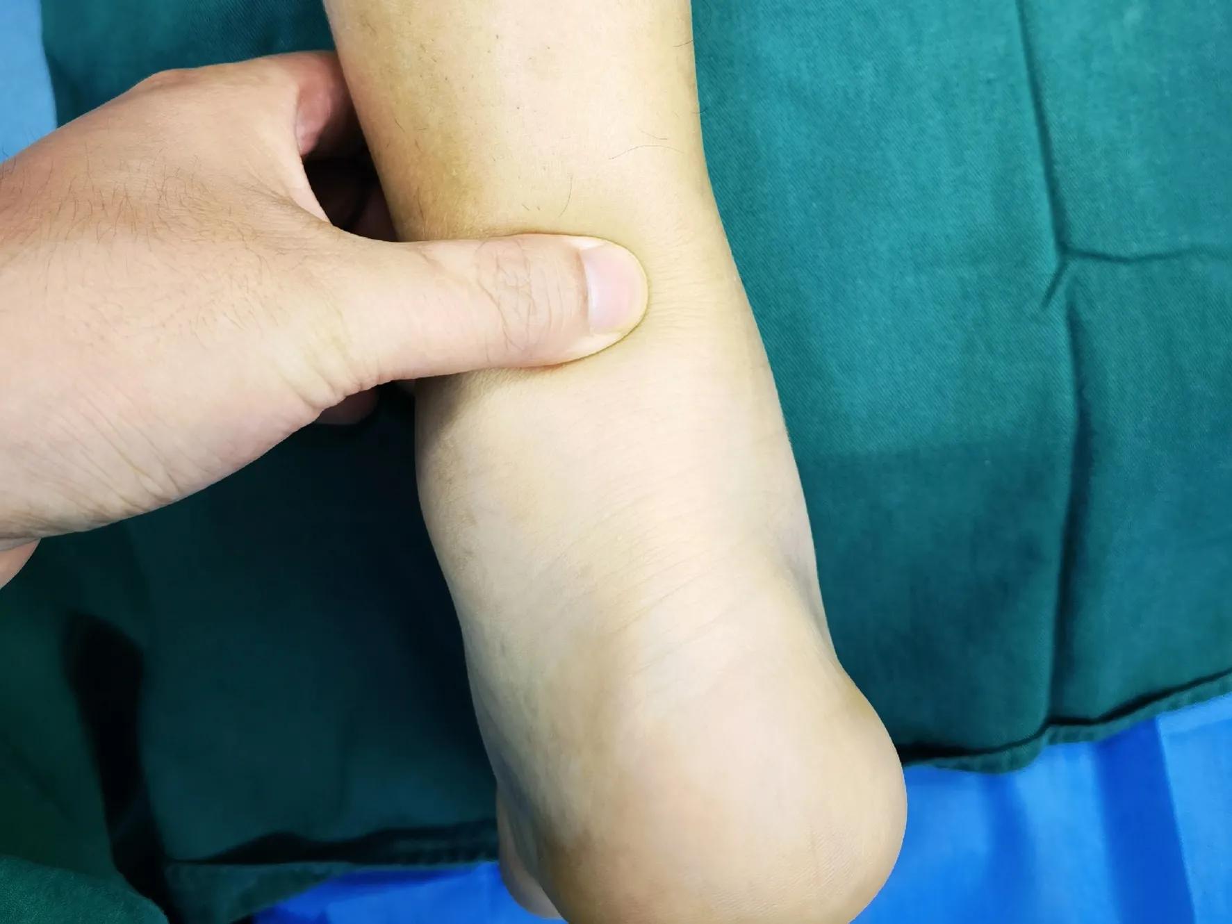 跟腱断裂术后疤痕增生怎么办,跟腱断裂术后跟腱如何愈合