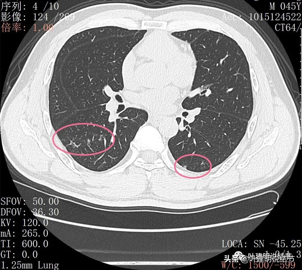 肺蜂窝状改变是肺癌吗,肺部陈旧灶与肿瘤怎么确诊