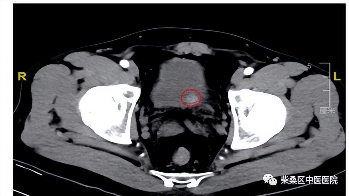 做ct喝水憋尿要多久,喝水憋尿做的尿常规准确吗