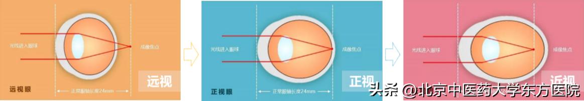 全国爱眼日治疗近视有优惠吗,世界爱眼日主题