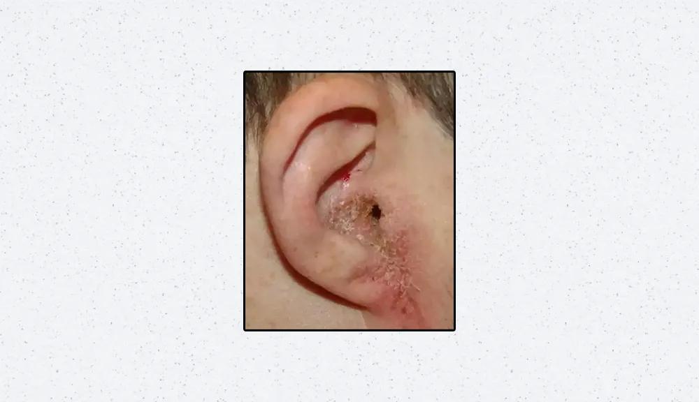 总是抠耳洞很痒怎么办,刚打的耳洞痒痒老想抠怎么办