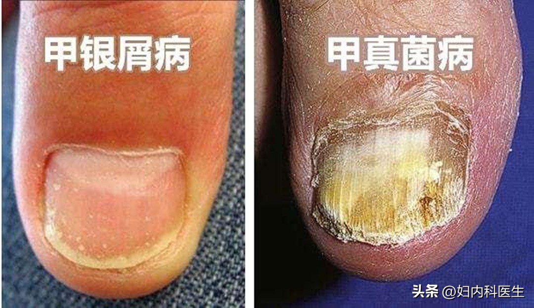 没有传染性的灰指甲,灰指甲没有甲板了怎么治