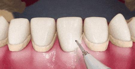 电动冲牙器便携式深层清洁牙齿,牙刷电动软毛护牙