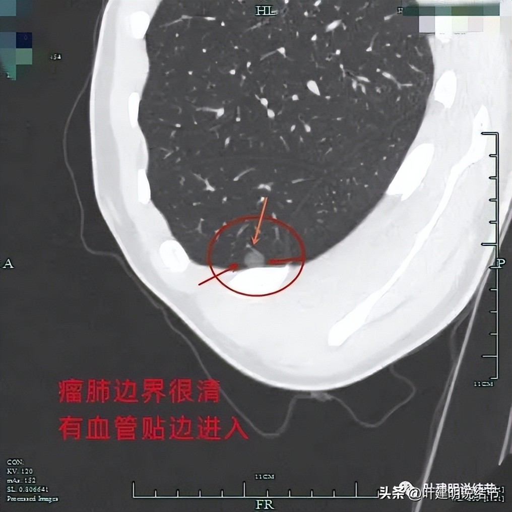 中叶多发微小结节,男性30岁右侧甲状腺单发结节