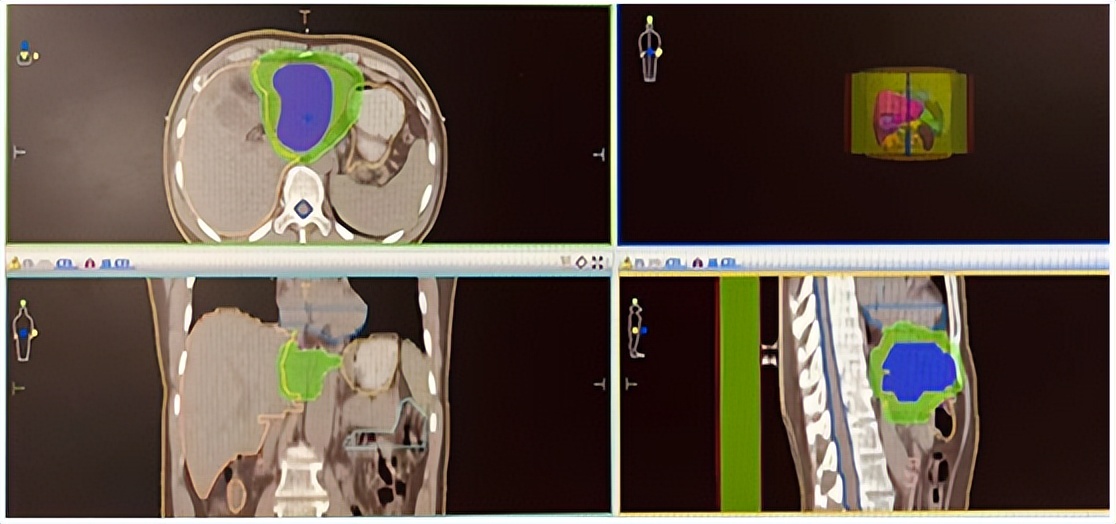 肝内胆管细胞癌免疫治疗成功案例,pbl治疗肝内胆管癌晚期转移有效吗