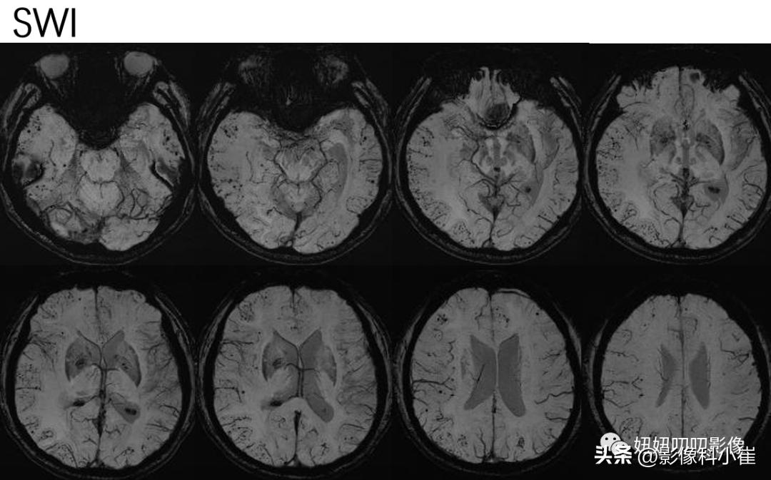 脑部肿瘤疾病有哪些,脑部有病变但是不是肿瘤