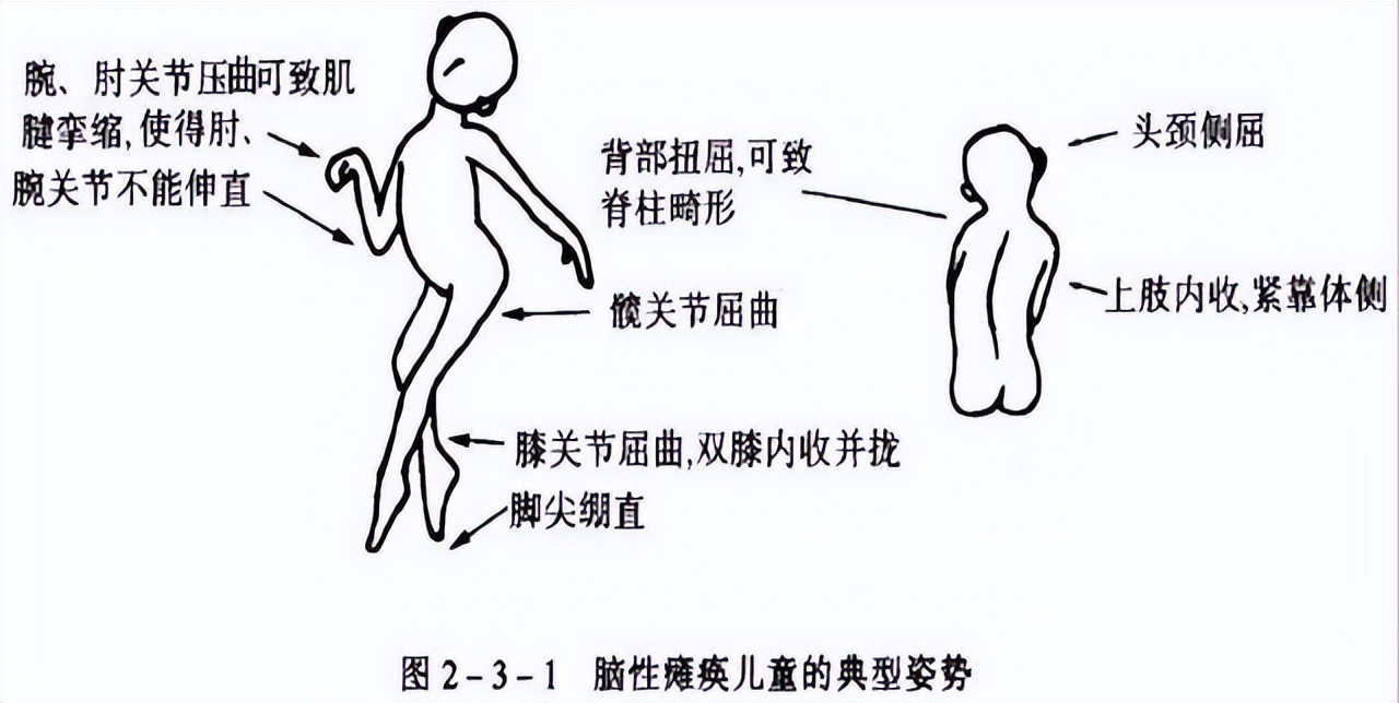 治疗脑瘫的方法,脑瘫治疗平台