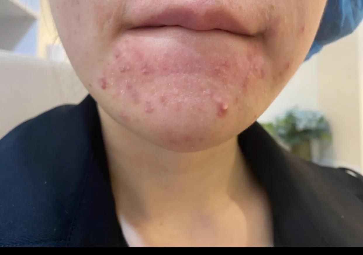 知柏地黄丸可以治脸上痘痘吗,知柏地黄丸能治疗痤疮吗