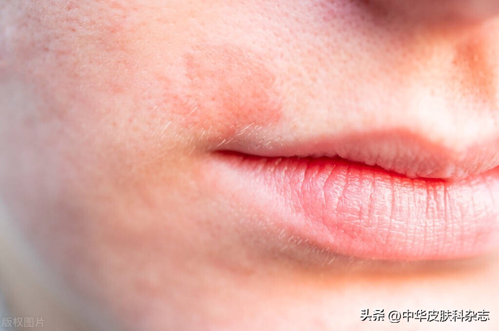 面部皮炎面部发红图片,面部皮炎图片是过敏吗