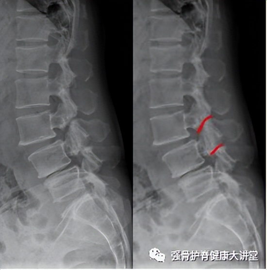「医学科普」腰椎峡部裂可以同时发生在多个节段