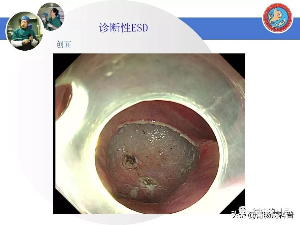 胃癌可以做内镜手术吗,早期胃癌内镜手术后追加外科手术