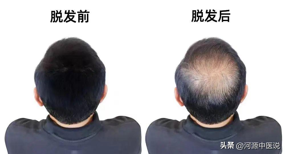 头发要秃了怎么预防,拒绝头秃保护头发的几点建议