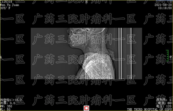 广州三甲医院宫颈癌筛查多少钱,广州哪家医院治疗宫颈癌最好的