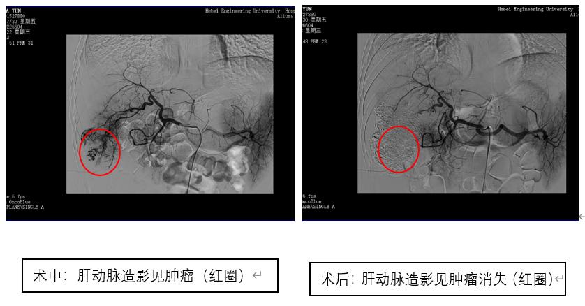 河北工程大学附属医院高质量发展,河北工程大学附属医院肿瘤