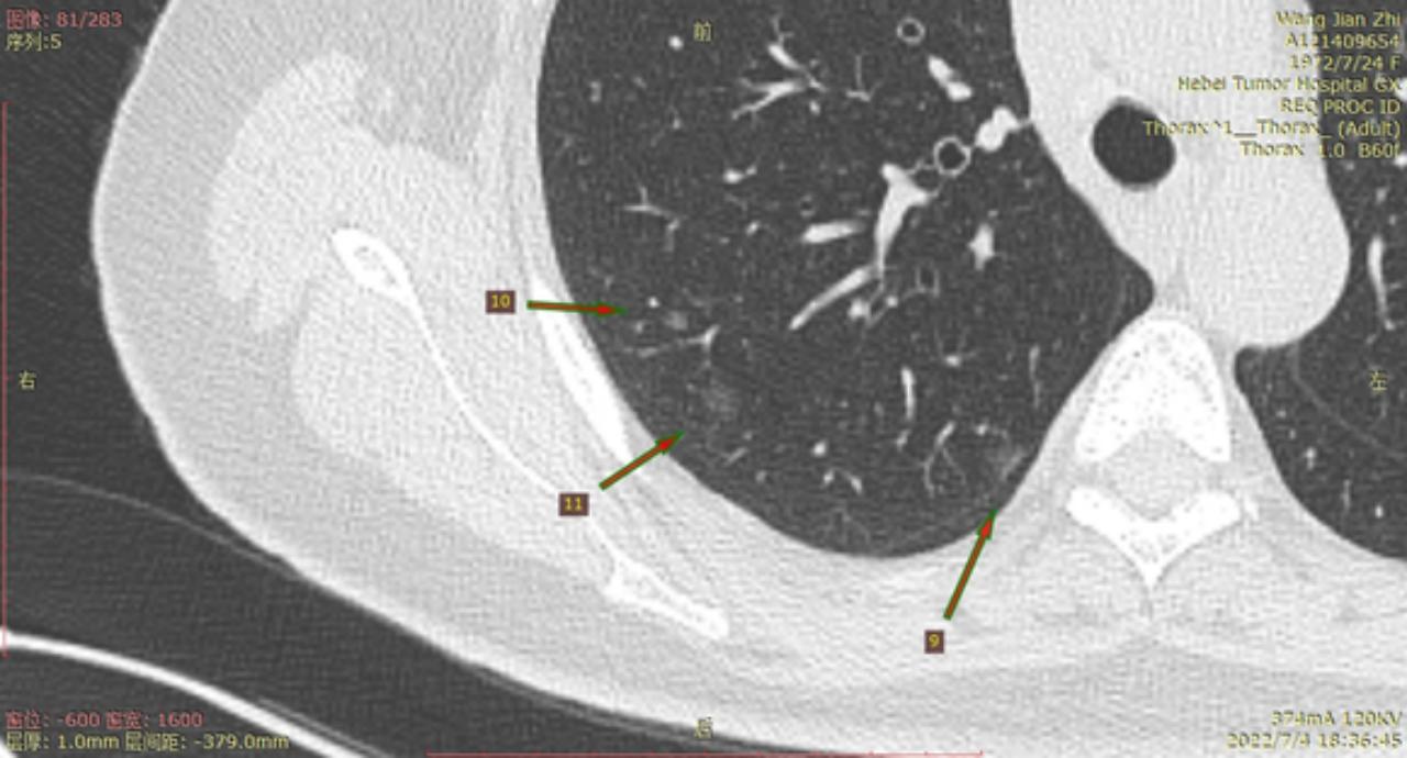首次发现磨玻璃结节要吃药消炎吗,磨玻璃结节警惕合并占位
