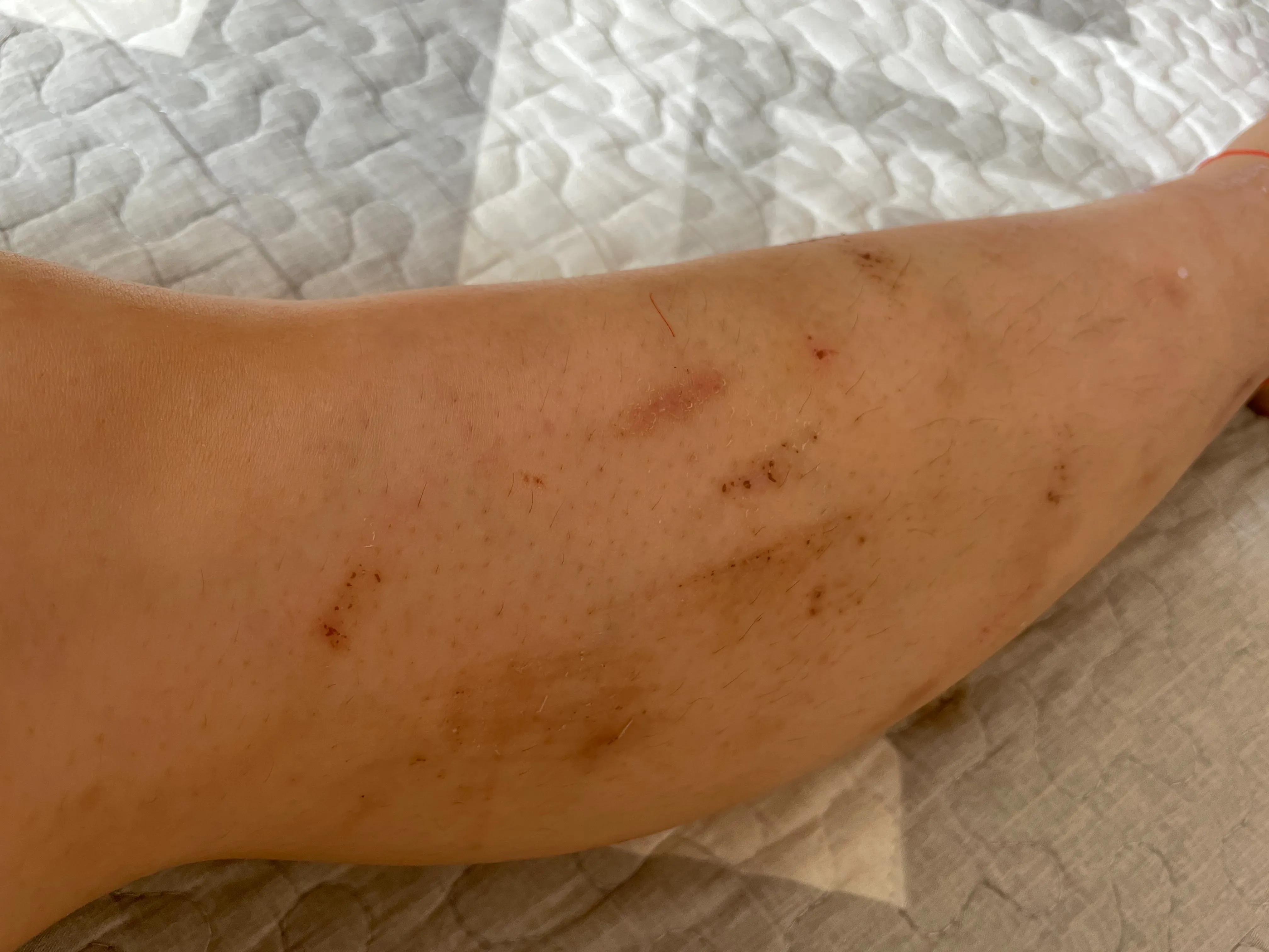 怎样去除腿上蚊子叮咬留下的疤痕,被蚊子叮咬留下的疤痕怎么消除