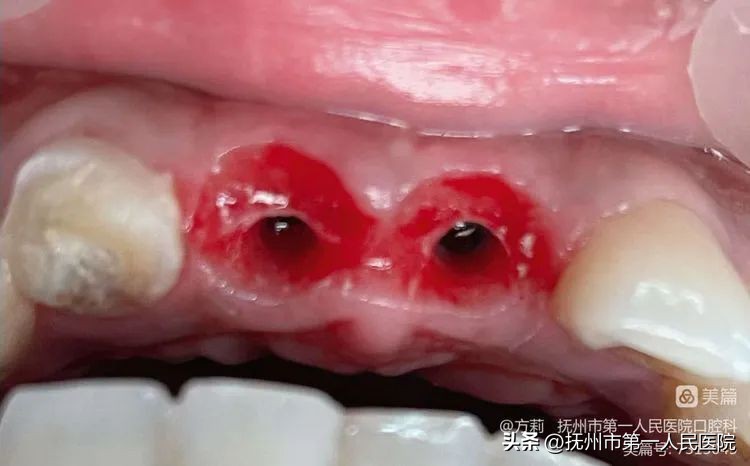 种植牙可修复多种牙齿缺失类型,学科建设口腔科