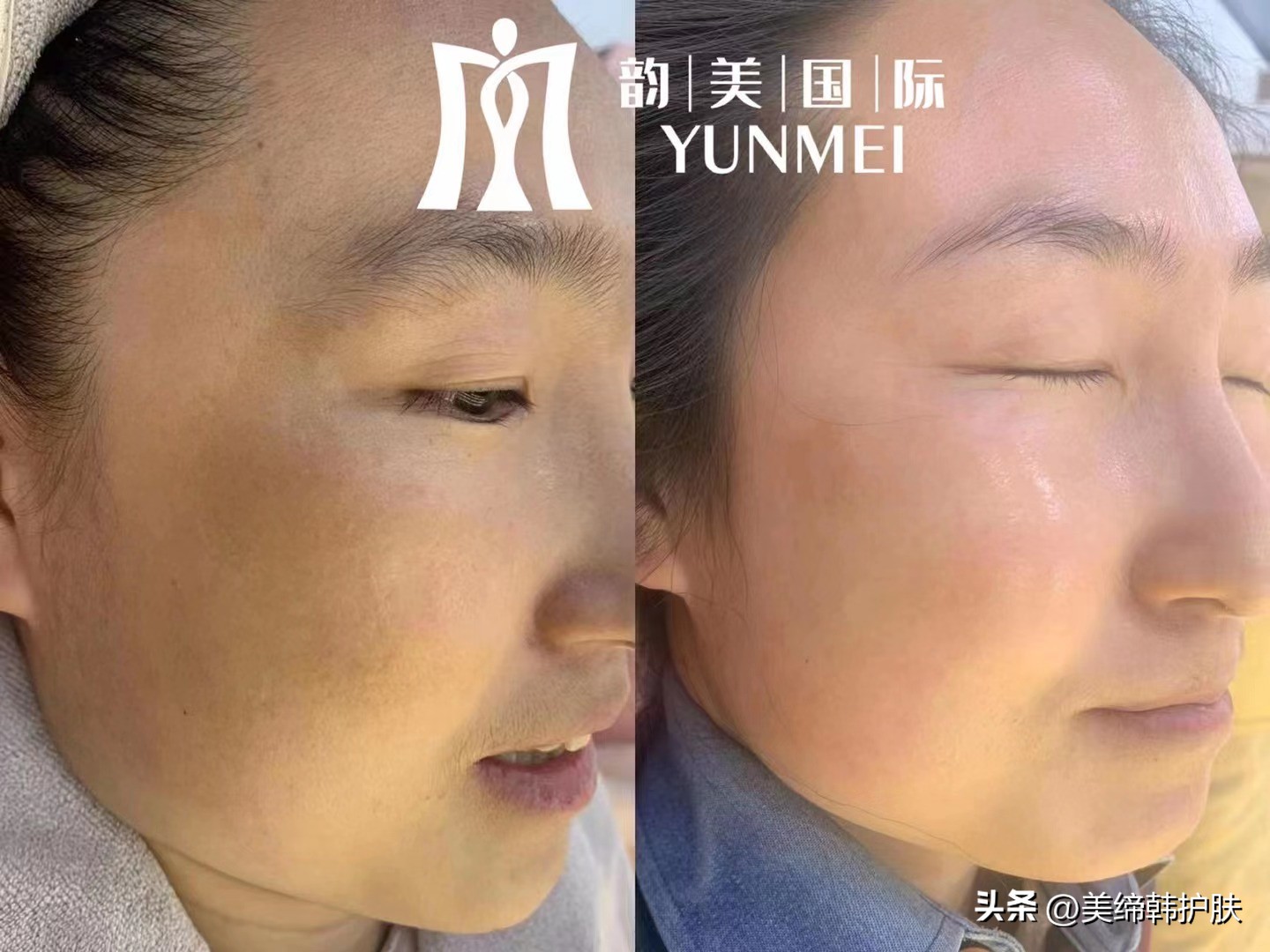 敏感肌泛红用什么护肤抗皱,如何正确认识敏感肌