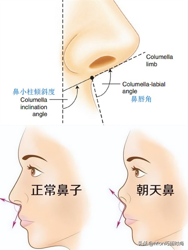 鼻子显凶显老怎么办,鼻子塌陷是不是显得人难看