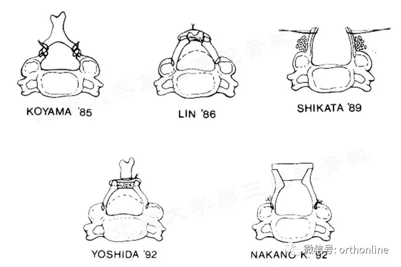 脊髓型颈椎病椎板成形术,椎间盘成形术指征