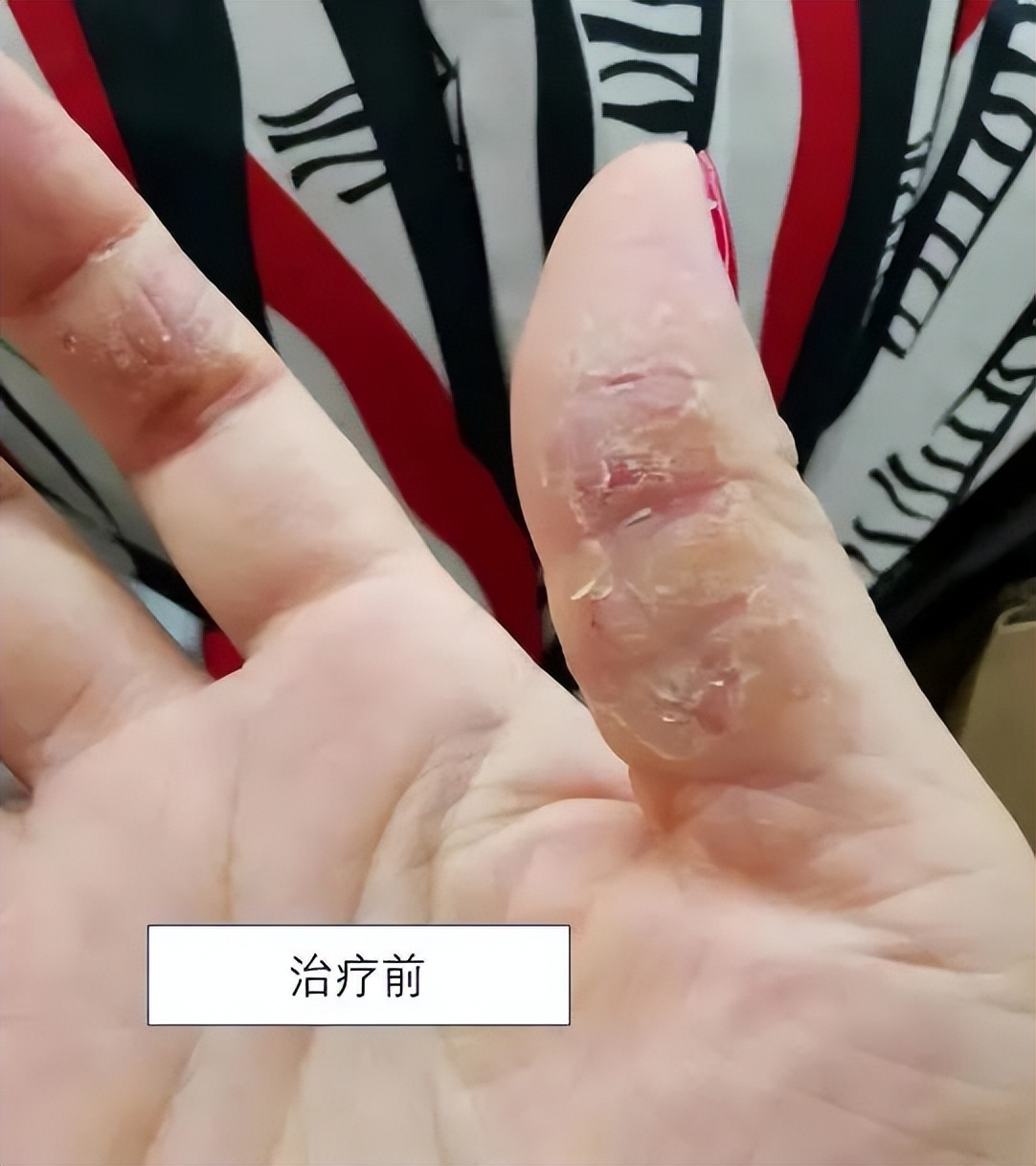 不用药祛湿疹最快最有效的方法,怎么零成本治湿疹