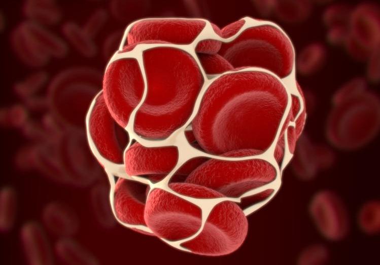 原发性血小板增多症的中医治疗,血小板增多症治疗最佳方法