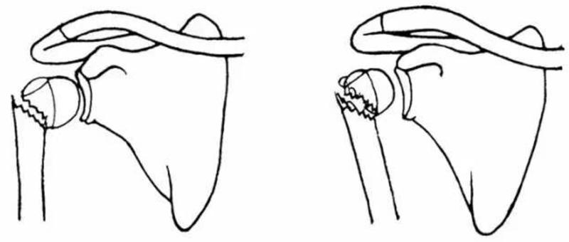 肱骨近端骨折属于几级伤残,肱骨近端骨折康复训练技巧