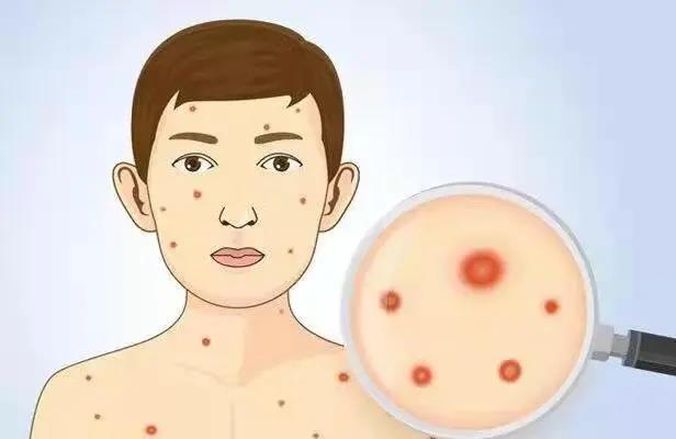水痘科普标题,水痘科普类短视频