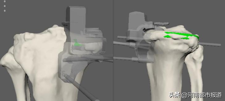 全球首例3d打印距骨表面假体置换,首例医生3d打印距骨表面植入人体