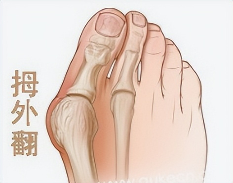 拇外翻会引起脚趾疼吗女性,为什么女人脚拇外翻的比较多