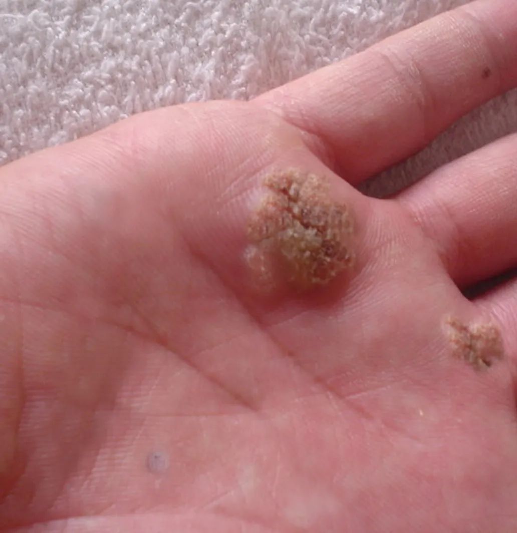 感染HPV都有些什么症状,感染hpv42没有症状有必要治疗吗