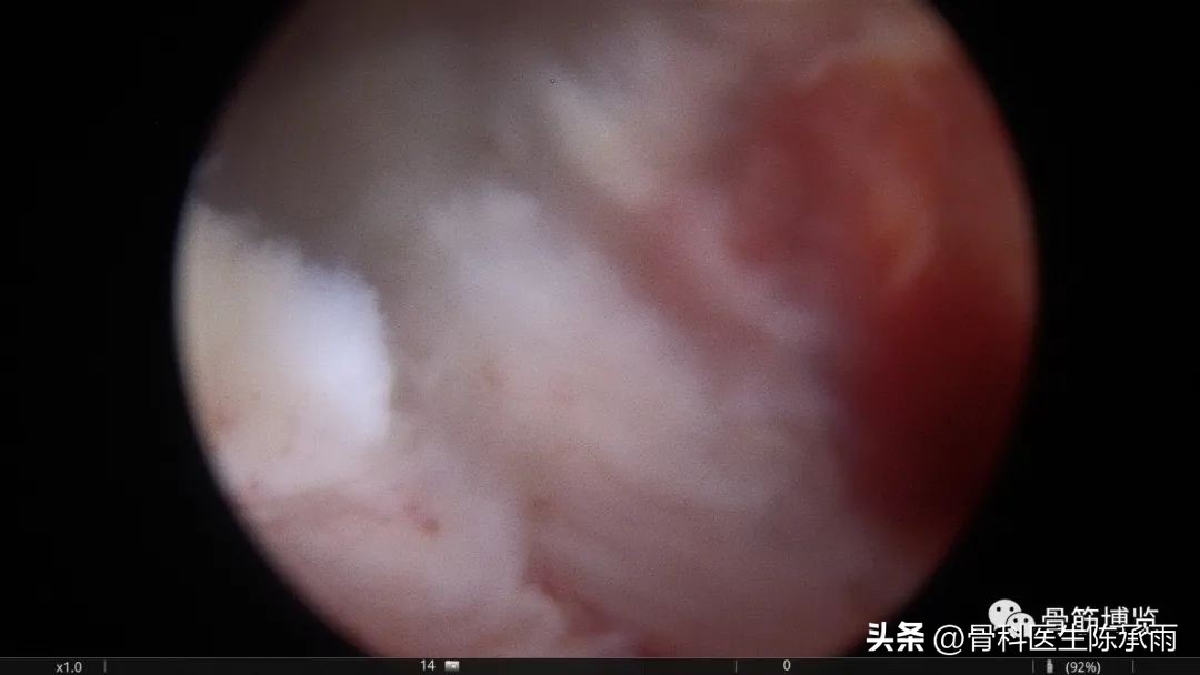 化脓性关节炎的穿刺引流治疗,关节炎镜下治疗