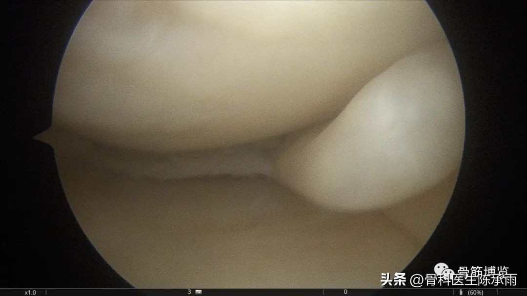 盘状半月板撕裂一级,半月板层裂愈合概率