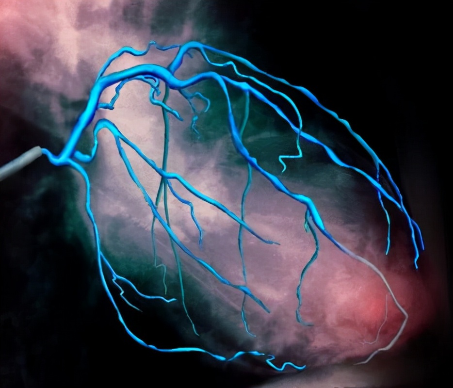 冠脉造影几类人不能做,冠脉造影之后的注意事项
