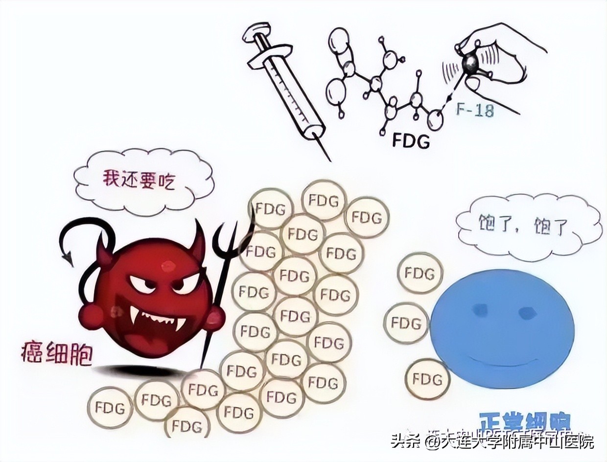 petct能识别所有肿瘤吗,petct影像中所有的亮点都是肿瘤吗