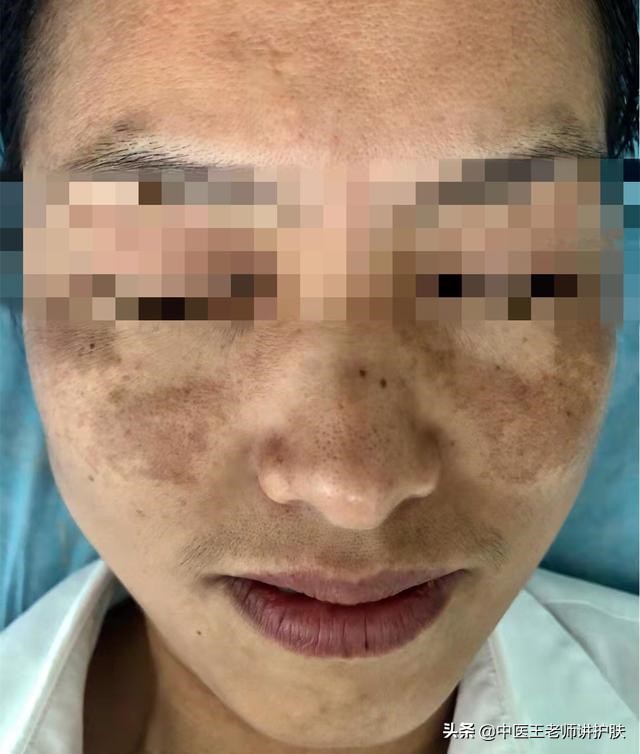 肝肾阴虚长斑怎么去掉,月经少长斑怎样调理