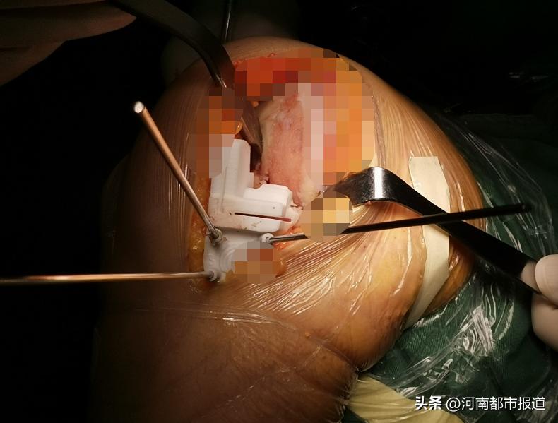 全球首例3d打印距骨表面假体置换,首例医生3d打印距骨表面植入人体