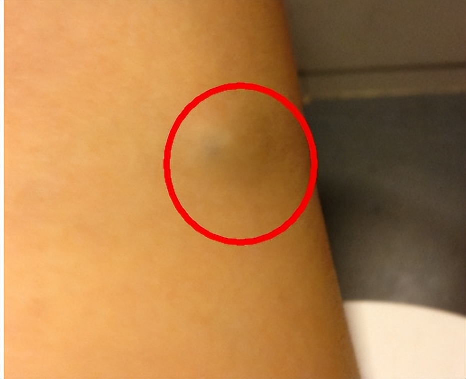 皮肤长的小肉球怎么自己处理,皮肤长出小肉球是什么原因