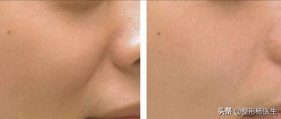 有法令纹特显老教你几招抚平细纹,法令纹这么显老得如何搞定