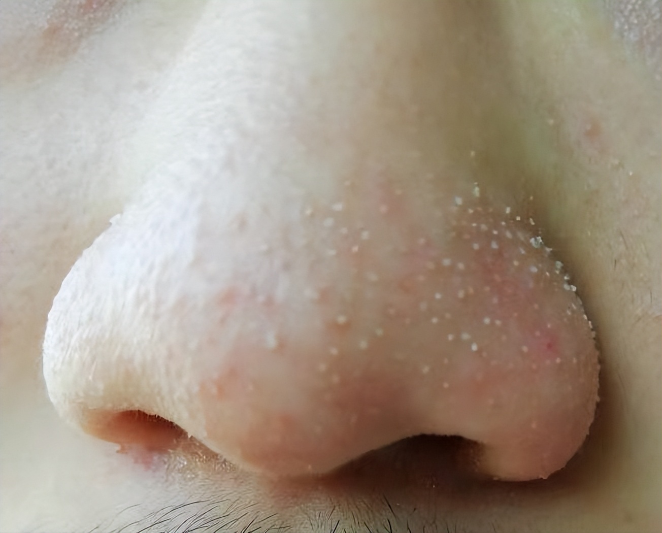 毛孔堵塞毛孔发黑怎样清理,毛孔长螨虫堵塞毛孔怎么办