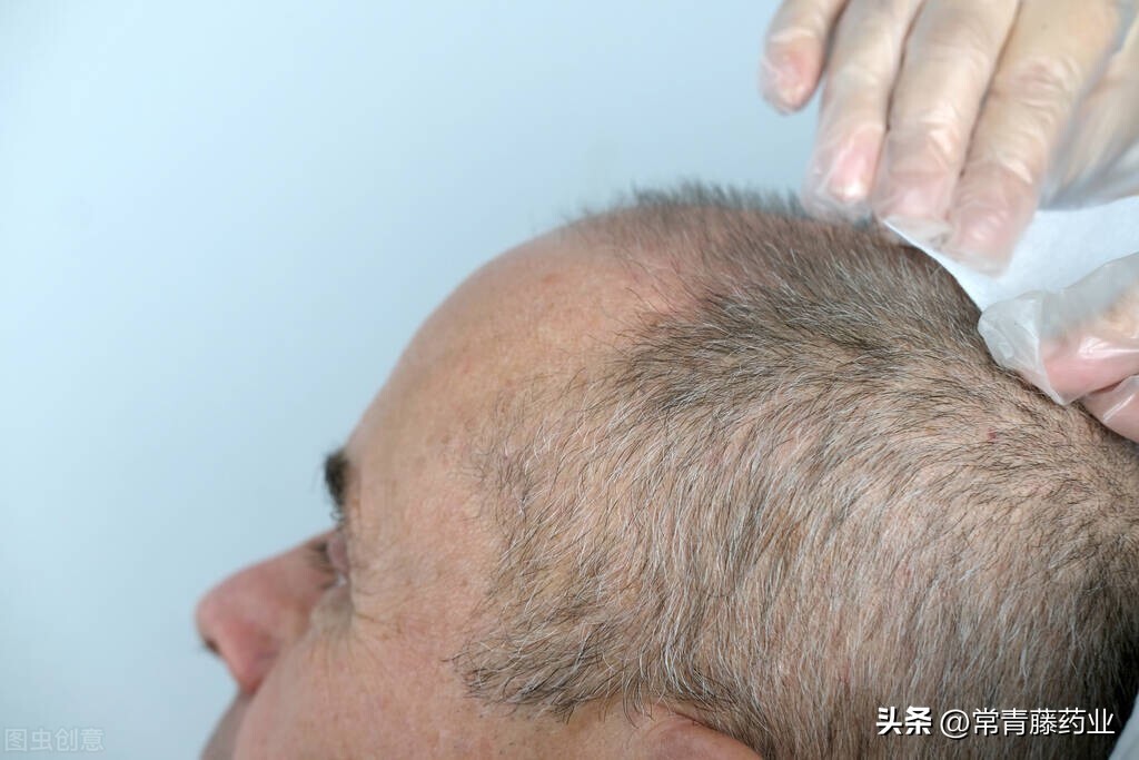 植发拆东墙补西墙感觉不舒服,植发是不是拆东墙补西墙