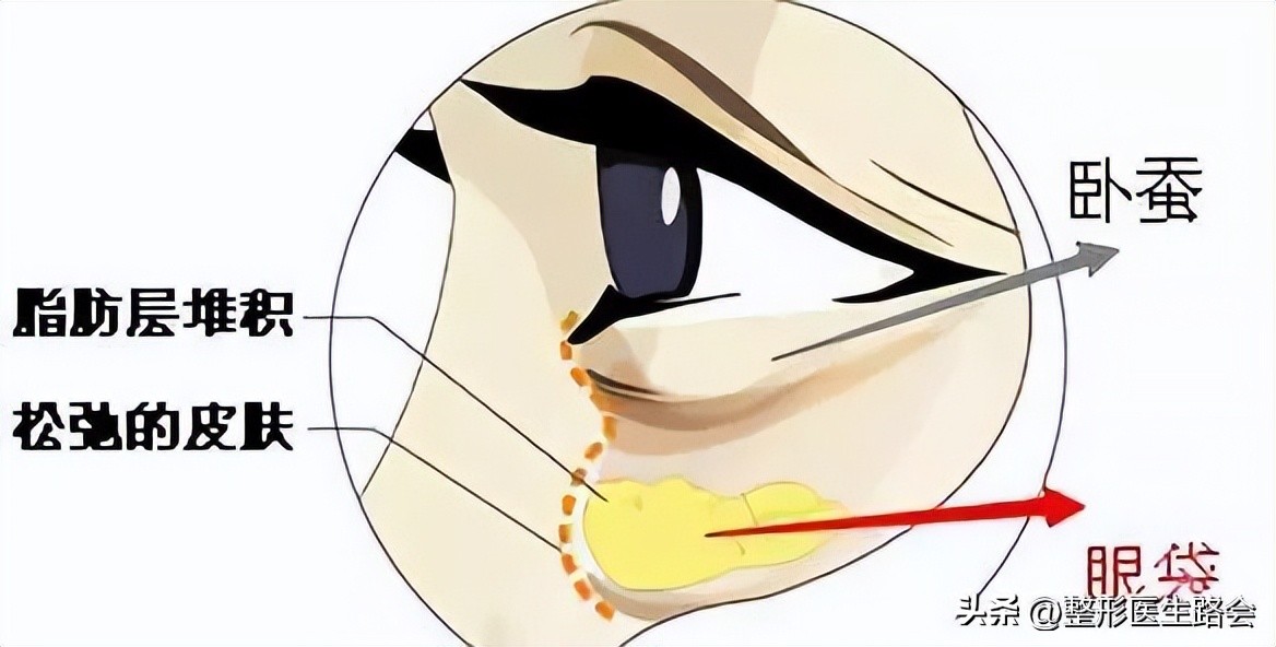 眼袋类型分不清,眼袋卧蚕傻傻分不清