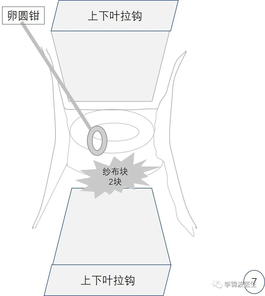 宫颈环扎术的详细步骤,宫颈环扎线拆除多少钱