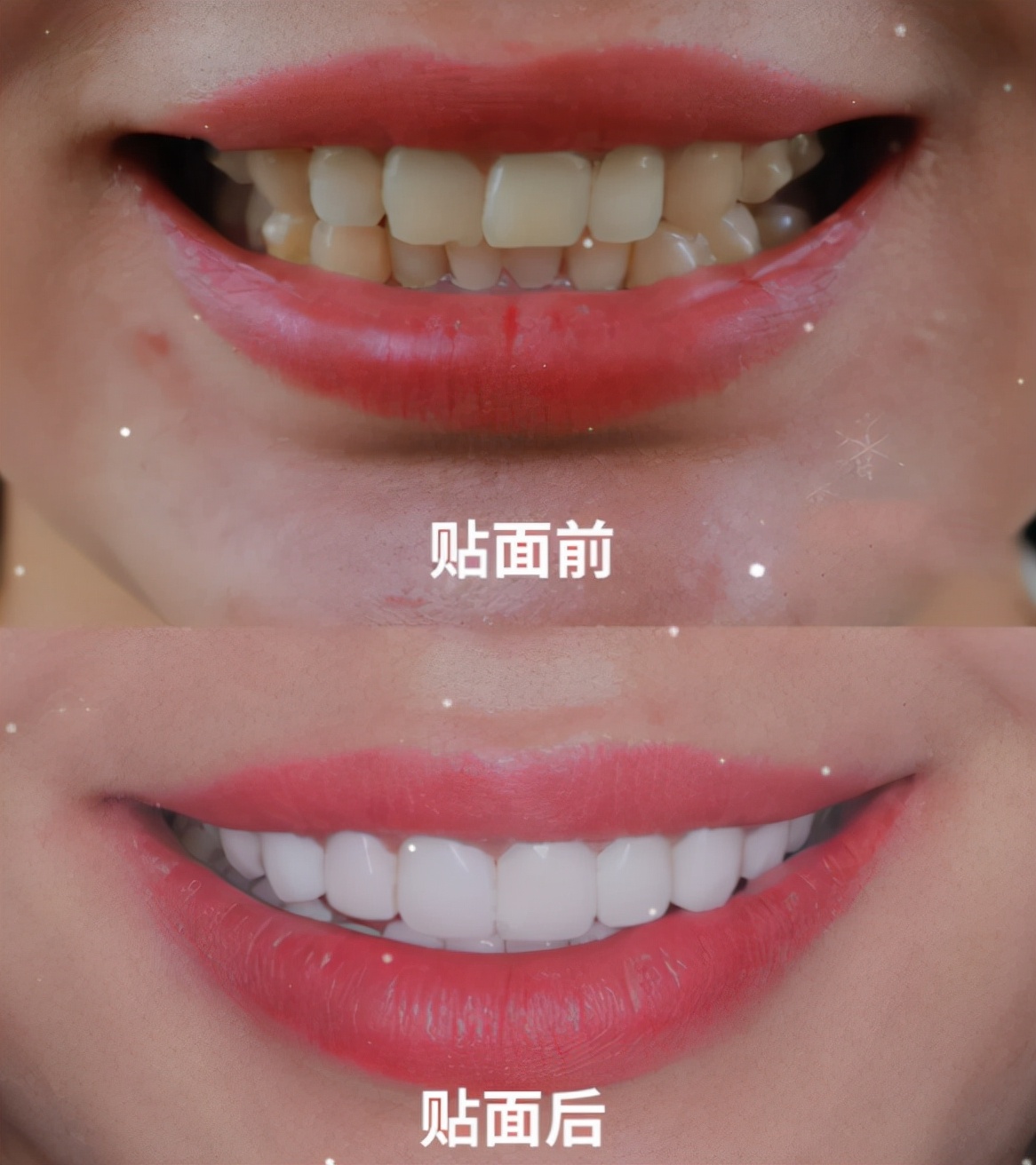 烤瓷牙的缺点危害亲身经历,烤瓷牙各有哪些优缺点