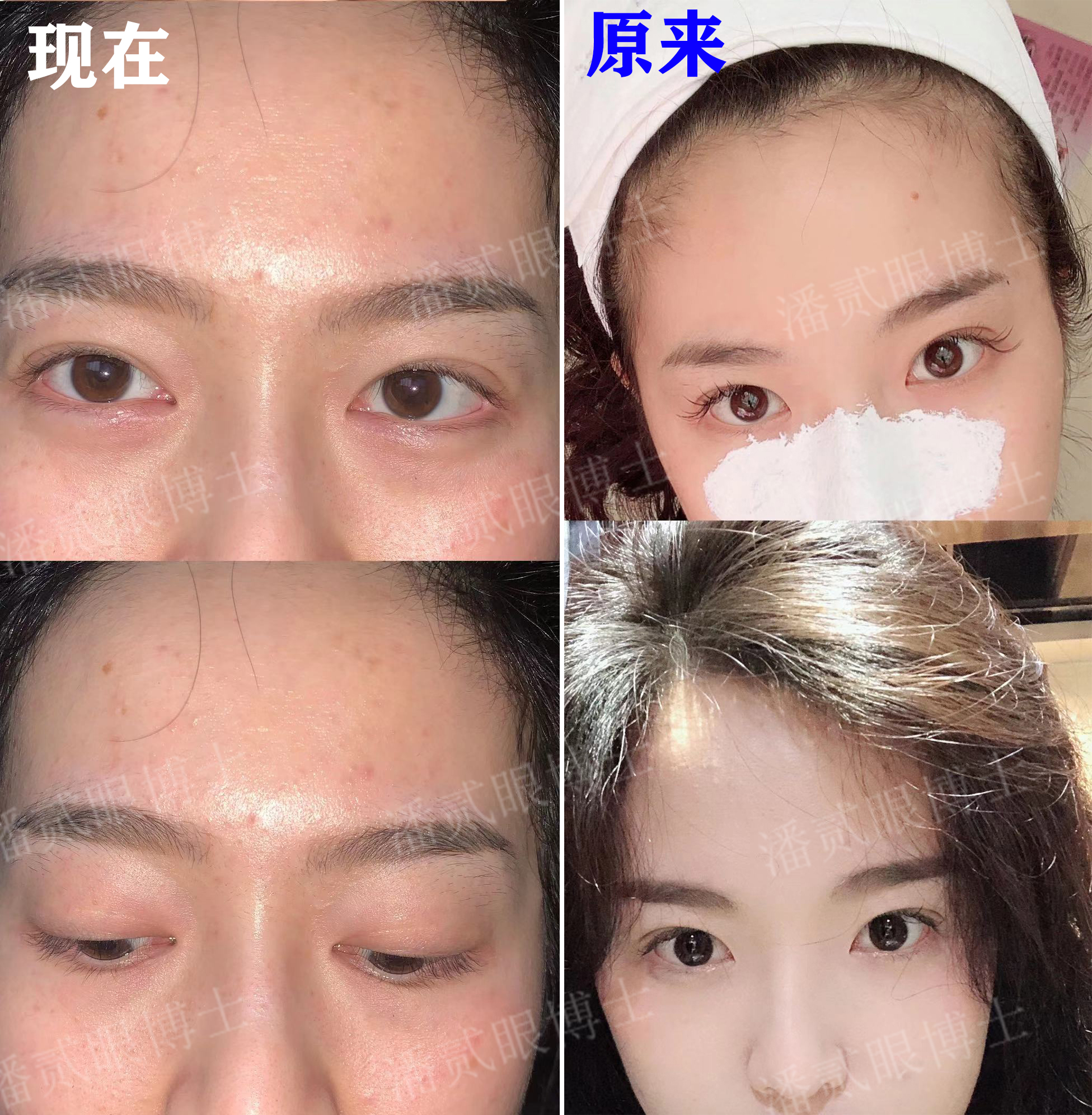 成都女子整容失败眼睛失明后续,整容眼角失败案例