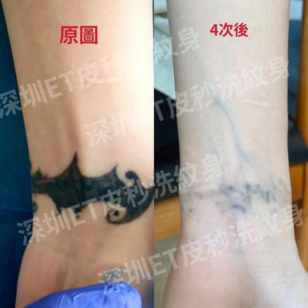 广州一次性洗纹身技术,深圳洗纹身不留疤哪家好